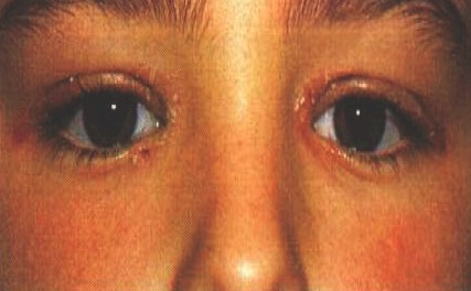 manifestaciones_oftalmologicas_enfermedades/afectacion_palpebral_psoriasis