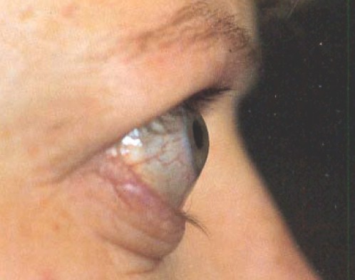 manifestaciones_oftalmologicas_enfermedades/miopatia_tiroidea_restrictiva