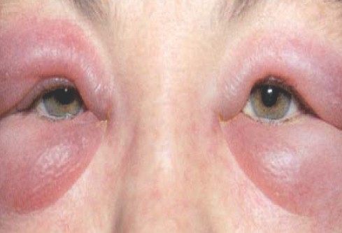 manifestaciones_oftalmologicas_enfermedades/oftalmopatia_eczema