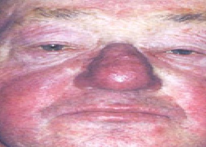 manifestaciones_oftalmologicas_enfermedades/oftalmopatia_rosacea