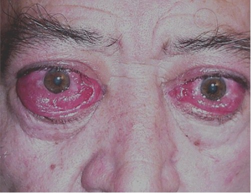 manifestaciones_oftalmologicas_enfermedades/oftalmopatia_tiroidea_restrictiva