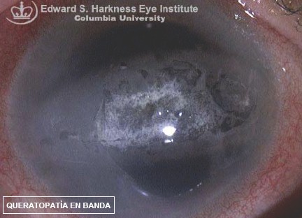 manifestaciones_oftalmologicas_enfermedades/queratopatia_en_banda
