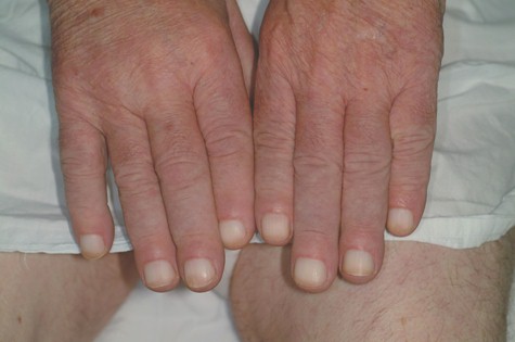 osteoatropatia_hipertrofica_carcinoma/acropaquia_leuconiquia_acropaquias osteoatropatia_hipertrofica_carcinoma/acropaquia_leuconiquia_acropaquias