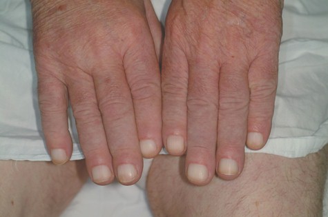 osteoatropatia_hipertrofica_carcinoma/acropaquia_leuconiquia_acropaquias