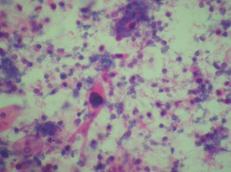 osteoatropatia_hipertrofica_carcinoma/citologia_carcinoma_epidermoide osteoatropatia_hipertrofica_carcinoma/citologia_carcinoma_epidermoide