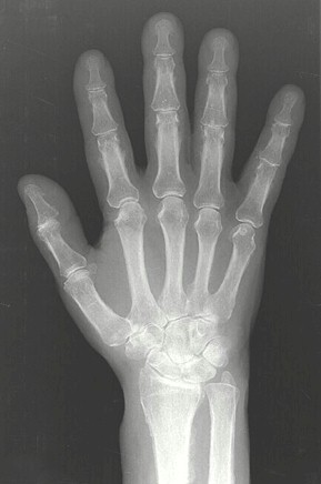 osteoatropatia_hipertrofica_carcinoma/reaccion_periostica_diafisis osteoatropatia_hipertrofica_carcinoma/reaccion_periostica_diafisis