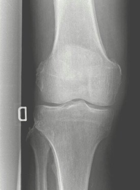 osteoatropatia_hipertrofica_carcinoma/reaccion_periostica_femur osteoatropatia_hipertrofica_carcinoma/reaccion_periostica_femur