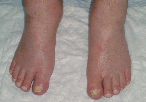 osteoatropatia_hipertrofica_carcinoma/zonas_acras_acropaquia osteoatropatia_hipertrofica_carcinoma/zonas_acras_acropaquia