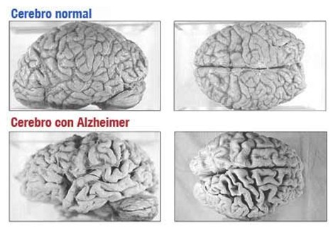 enfermedad_de_alzheimer/cerebro_normal_enfermo