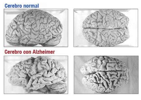 enfermedad_de_alzheimer/cerebro_normal_enfermo enfermedad_de_alzheimer/cerebro_normal_enfermo