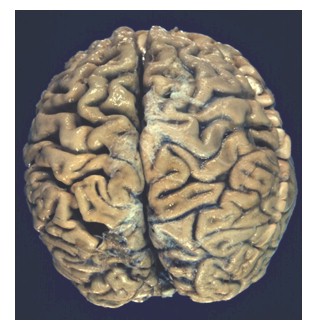enfermedad_de_alzheimer/cortex_corteza_cerebral enfermedad_de_alzheimer/cortex_corteza_cerebral