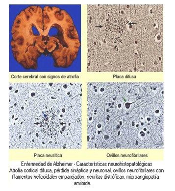 enfermedad_de_alzheimer/histologia_atrofia_cortical.