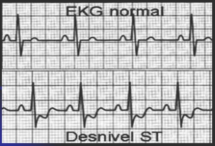 infarto_agudo_miocardio/ECG_ST_IAM