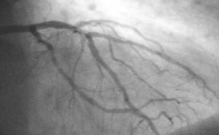 infarto_agudo_miocardio/angiografia_coronariografia