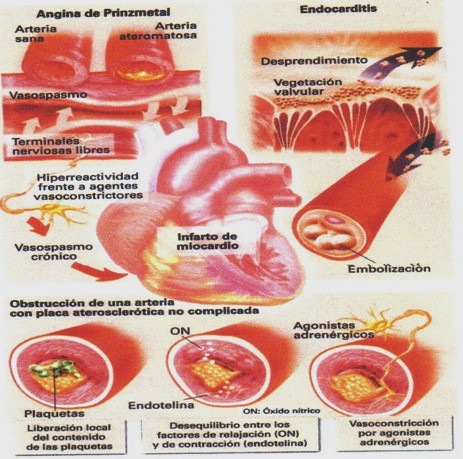 infarto_agudo_miocardio/causas_no_ateroscleroticas