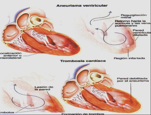 infarto_agudo_miocardio/complicaciones_IAM