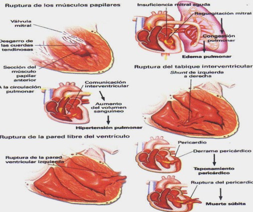 infarto_agudo_miocardio/complicaciones_mecanicas_IAM