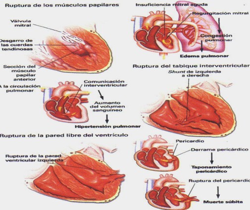 infarto_agudo_miocardio/complicaciones_mecanicas_IAM infarto_agudo_miocardio/complicaciones_mecanicas_IAM