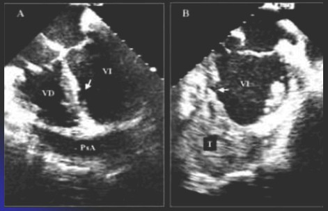 infarto_agudo_miocardio/ecocardiograma_ecocardiografia