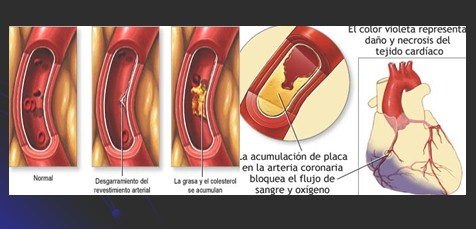 infarto_agudo_miocardio/formacion_ateroma