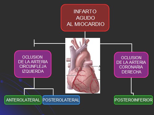 infarto_agudo_miocardio/oclusion_arterias_coronarias