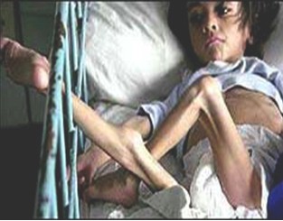 Kwashiorkor - JungleKey.fr Image Kwashiorkor - JungleKey.fr Image