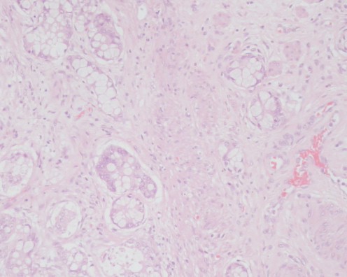 _tumor_globoide_adenocarcinoma/eosinophilic_granular_cytoplasm