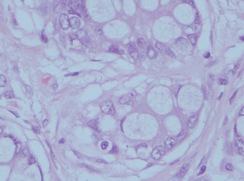 tumor_globoide_adenocarcinoma/focally_granular_cytoplasm