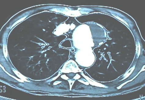 aneurisma_aorta_toracica/TAC_contraste_trombo aneurisma_aorta_toracica/TAC_contraste_trombo