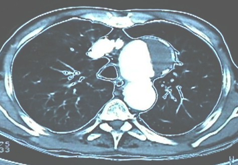 aneurisma_aorta_toracica/TAC_contraste_trombo