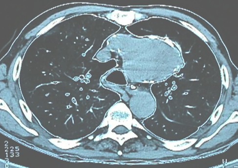 aneurisma_aorta_toracica/TAC_toracico_torax