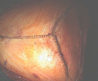 aneurisma_aorta_toracica/cirugia_incision