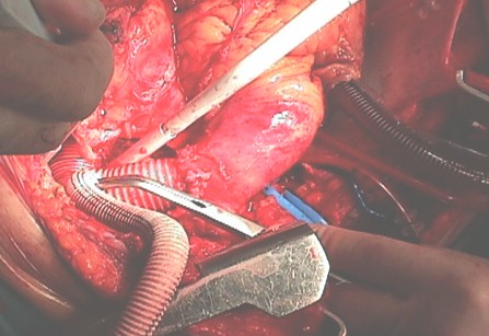 aneurisma_aorta_toracica/cirugia_protesis_dacron