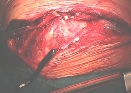 aneurisma_aorta_toracica/costotomia_adherencias aneurisma_aorta_toracica/costotomia_adherencias