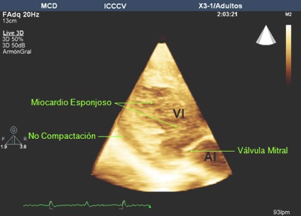 caso_miocardio_espongiforme/3d_ecocardiograma_eco
