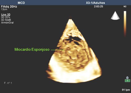 caso_miocardio_espongiforme/esponjoso_ecocardiograma_eco