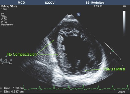 caso_miocardio_espongiforme/no_compactacion_miocardica