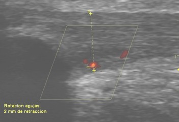 entesopatia_rotuliana_futbol/ecografia_tendon_neovascularizacion entesopatia_rotuliana_futbol/ecografia_tendon_neovascularizacion