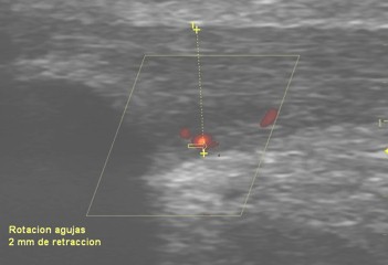 entesopatia_rotuliana_futbol/ecografia_tendon_neovascularizacion