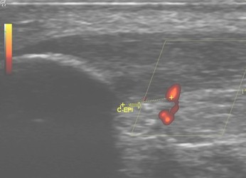 entesopatia_rotuliana_futbol/ecografia_tendon_rotuliano