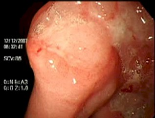 evolucion_linfoma_MALT/videoendoscopia_tumor