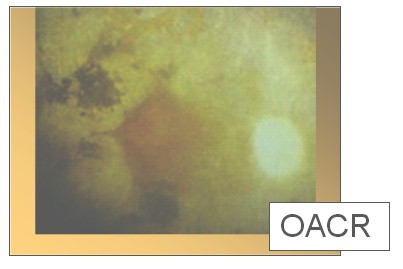 lesiones_vasculares_retina/oclusion_arteria_central_retina lesiones_vasculares_retina/oclusion_arteria_central_retina