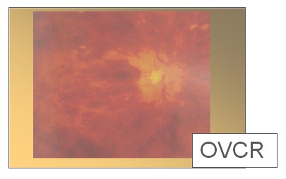 lesiones_vasculares_retina/oclusion_vena_central_retina lesiones_vasculares_retina/oclusion_vena_central_retina
