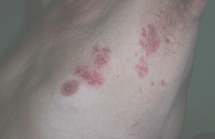 oxigenacion_hiperbarica_herpes/zoster_lesiones_OHB oxigenacion_hiperbarica_herpes/zoster_lesiones_OHB