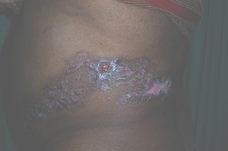 oxigenacion_hiperbarica_herpes/zoster_lesiones_cutaneas oxigenacion_hiperbarica_herpes/zoster_lesiones_cutaneas