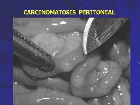 quimioterapia_intraperitoneal_hipertermia/carcinomatosis_peritoneal quimioterapia_intraperitoneal_hipertermia/carcinomatosis_peritoneal