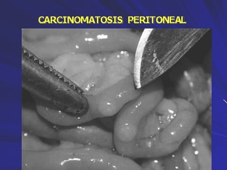 quimioterapia_intraperitoneal_hipertermia/carcinomatosis_peritoneal