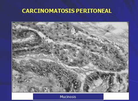quimioterapia_intraperitoneal_hipertermia/mucinosis_anatomia_patologica quimioterapia_intraperitoneal_hipertermia/mucinosis_anatomia_patologica