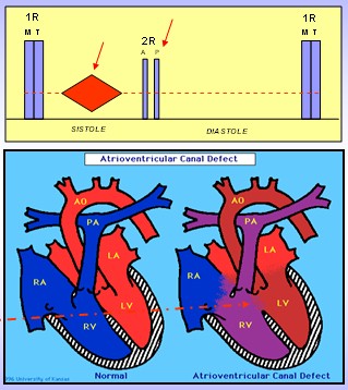 cardiopatias_congenitas/CIA_auscultacion_bloqueo