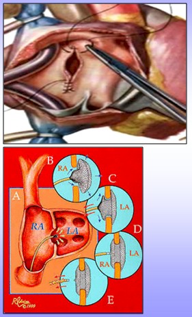 cardiopatias_congenitas/CIA_tratamiento_cirugia